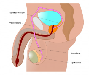 vasectomy Sperm viability and