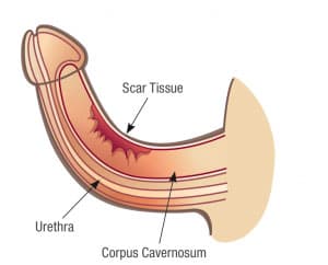 curved painful penis